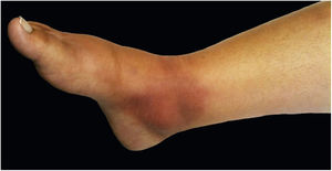 Hypersensitivity phenomenon. Erythema and edema over the medial malleolus compatible with erythema nodosum.