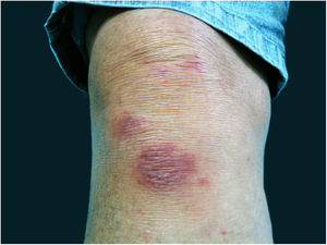 Hypersensitivity phenomena. Fixed cutaneous sporotrichosis with erythema multiforme hypersensitivity phenomenon.