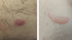 Vesico-bullous lesions in a patient with COVID-19.