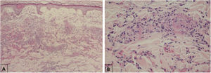 Histopathological findings of exanthem in a patient with COVID-19. (A), Leukocytoclastic vasculitis in the capillary vessels of the superficial dermis and erythrodiapedesis (Hematoxylin & eosin, ×100). (B), Capillary vessels containing intact and degenerated neutrophils partially destroying the wall, extravasated red blood cells, and the presence of eosinophilic amorphous material in the vascular lumen, suggestive of fibrin thrombus (Hematoxylin & eosin, ×400).