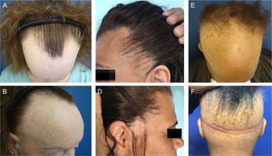 (A and B), Male pattern of FFA; (C and D), Plaque pattern; (E and F), Ophiasic pattern.