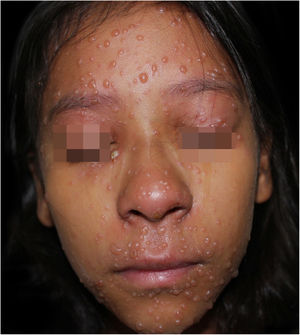 At hospital admission, on the fifth day of disease evolution, with vesicles and bullae on the face and a pustule on the right lower eyelid.