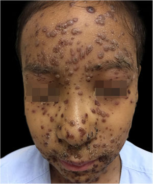 At the seventh day of intravenous acyclovir, with a regressing bullous eruption and crusts.
