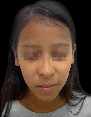 Sixty days after hospital discharge, with residual hypochromic spots.