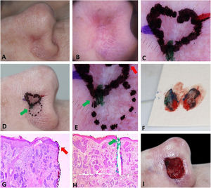 Preoperative demarcation of suspicious areas based on dermoscopy. (A–B), Ill-defined infiltrative BCC. (C), First stage margins. (D–E), Suspicious area marked with a dotted line in case it was necessary to remove it. F, Surgical specimen inked. (G–H), BCC on the green and red markings (Hematoxylin & eosin, ×25). (I), Final surgical defect.