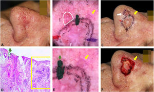 Correlation of dermoscopic and histopathological findings when margins are positive. (A), Ill-defined BCC. (B), Dermoscopic mapping. After a careful assessment, the white area was included in the first stage margin. (C), First stage margins. (D), Positive lateral margin (yellow rectangle) adjacent to the green marking (Hematoxylin & eosin, ×25). (E), The yellow arrow indicates the area corresponding to the positive histopathologic margin; with white, red structureless areas on dermoscopy. (F), Final defect. The yellow arrow indicates the area removed in the second stage.