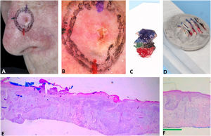 Debulking mapping. (A), Ill-defined BCC. (B), Dermoscopy of the tumor. (C), Debulking mapped similarly to dermoscopy. (D), Debulking vertical sections prior to inclusion. (E–F), Histopathology showed predominantly infiltrative BCC in the blue area and superficial subtype in the green area (Hematoxylin & eosin, ×40).