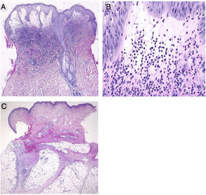 (A), Histological features showing dense neutrophilic infiltration throughout the edematous dermis (Hematoxylin & eosin, original magnification ×40). (B), Higher magnification showing the large number of infiltrating neutrophils (Hematoxylin & eosin, ×400). (C), Histological examination showing a septal panniculitis in the subcutaneous nodule in the lower extremity (Hematoxylin & eosin, ×20).