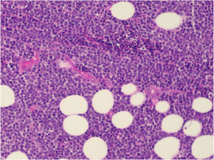 Large cell non-Hodgkin lymphoma infiltrating the inguinal lymph node, extending to the adipose tissue around the lymph node (Hematoxylin & eosin, ×200).