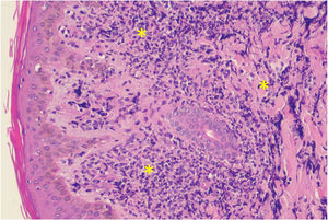 Histopathology of a skin fragment of the thigh. Neoplastic lymphocytes (*) diffusely infiltrating the dermis (Hematoxylin & eosin, ×200).