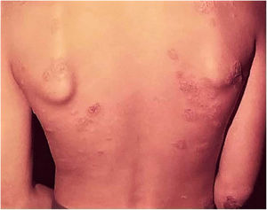 Post-BCG TVC – disseminated annular lesions on the trunk and upper limbs.