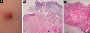 (A), A reddish firm nodule with central crusts on the upper arm. (B), A perforated pilomatricoma lesion with elimination of pilomatricoma cells (Hematoxylin & eosin stain; ×40). (C), Histopathology of another nodule, showing central ulceration and an eosinophilic tumor mass with peripheral basaloid tumor cells (Hematoxylin & eosin stain; ×40).