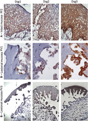 Immunohistochemistry panel with Dsg1, Dsg2 and Dsg3 expressions in mucosal samples. (A), PF-intact mucosa showing the typical distribution of Dsg1, Dsg2 and Dsg3 in the epithelium (original magnification: ×63). (B), PV-lesional mucosa showing Dsg2 and Dsg3 expression surrounding the acantholytic bulla (original amplification: ×100 and ×40).