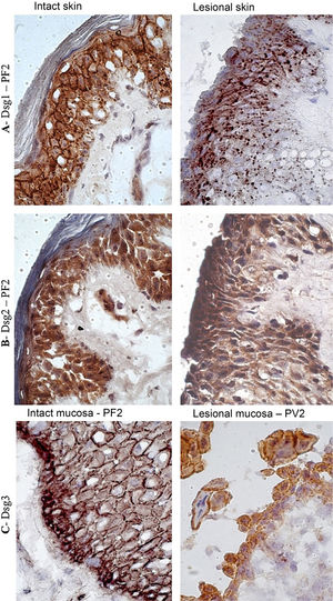 Immunohistochemistry panel with Dsg1, Dsg2 and Dsg3 expressions in skin and mucosa samples from patients with PF and PV. (A), Dsg1 in intact and lesional skin samples from patient PF2 showing conspicuous intercellular and intracytoplasmic granules (Dsg1 internalization), widely distributed in lesional skin (original magnification: ×100). (B), Dsg2 comparing intact and lesional skin sample from patient PF2, confirming the absence of granules (original magnification: ×100). (C), Dsg3 comparing intact mucosa sample from patient PF2 and lesional mucosa from patient PV3, showing fine intercellular and intracytoplasmic granules (Dsg3 internalization) in the lesional mucosa (original magnification: ×100).