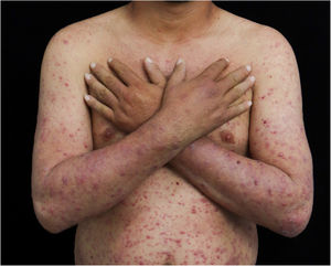 Presence of papules, pustules and crusts on the upper limbs and trunk.