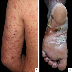 (A), Erythematous papules, pustules and crusts affecting the left upper limb. (B), Bullae with purulent content on the left plantar region.