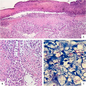 (A), Necrosis of the epidermis and dense inflammatory infiltrate in the dermis are observed (Hematoxylin & eosin, ×10). (B), Neutrophilic infiltrate on the wall and around the vessels (Hematoxylin & eosin, ×40). (C), Vacuolated macrophages containing large amounts of intact and fragmented bacilli (Wade, ×40).