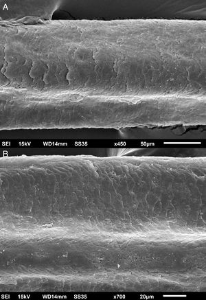 Scanning Electron Microscopy – Eyelash examination – (A), high magnification, showing grooving in the hair shaft and cuticle irregularity (×450). (B), High magnification, showing two grooves in the hair shaft – arrows (×700).