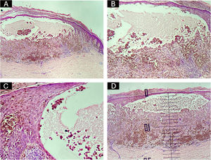 Bullous lesion containing isolated and clustered malignant melanocytic cells.