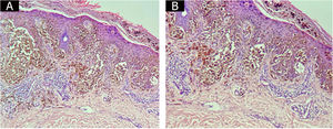 Bullous lesion borders containing tumor cells and loss of intercellular adhesions.