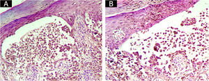 Bullous lesion containing tumor cells.