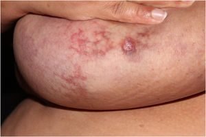 Large and pendulous breasts, with erythematous-violaceous reticulated plaques and some ulcerated areas.