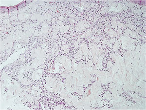Proliferation of small vessels, more intense in the upper dermis, extending to the middle dermis (Hematoxylin & eosin, ×200).