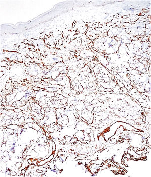 Immunohistochemistry enhancing the vascular endothelial proliferation with CD34.