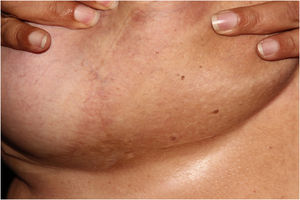 Complete resolution of lesions after loss of 20 kg.