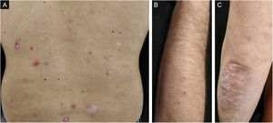 Guttate psoriasis and chronic plaque psoriasis flare (case 1): (A) Guttate psoriasis drop-like erythematous plaques and scaly erythematous plaques on the trunk; (B) Guttate psoriasis drop-like erythematous plaques on the upper limbs; (C) Scaly erythematous plaques on the elbows.