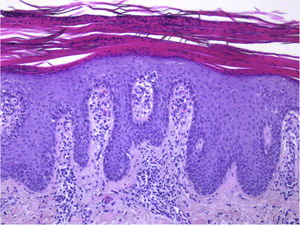 Guttate psoriasis histopathologic aspects (case 1) (Hematoxylin & eosin ×100): Psoriasiform hyperplasia of the epidermis, featuring neutrophils overlying continuous parakeratosis and intracorneal micro-abscesses; absence of stratum granulosum; papillomatosis with vascular hyperplasia and perivascular lymphocytic infiltrate in the superficial dermis.