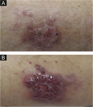 (A), First patient – Erythematous scaly plaque on the right leg. (B), Second patient – Violaceous granulomatous nodule surrounded by small erythematous papules on the left thigh.