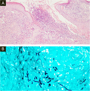(A), Histopathology of the surgical specimen of the first patient shows diffuse oedema and mixed inflammatory cells with formation of micro abscesses the hyaline, hyphae in multinucleated giant cells with surrounding neutrophils (Hematoxylin & eosin, ×100). (B), Positive Grocott’s methenamine silver stain with multiple branching septate hyphae (×400).