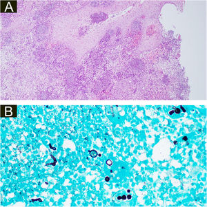 (A), Histopathology of the surgical specimen of the second patient demonstrating pseudoepitheliomatous hyperplasia, exocytosis of neutrophils and lymphocytes, diffuse oedema mixed inflammatory cells with formation of micro abscesses in the dermis and dermal capillary proliferations, with fungal hyphae (basophilic globular structures) in the multinucleated giant cells (Hematoxylin & eosin, ×100). (B), Grocott’s methenamine silver stain branching septate hyphae and multiple round yeast-like structures with pseudobudding (×400).
