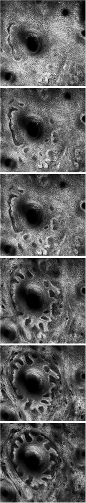 VivaStack imaging of the dilated follicule with finger-like protrusions around the follicle.