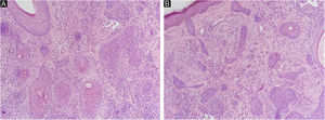 (A), Multiple radiate small abortive hair follicles of varying maturity degrees around central located primary follicle (Hematoxylin & eosin ×100). (B), Some abortive hair follicles located beneath the epidermis (Hematoxylin & eosin ×100).