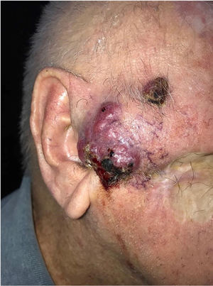 Extraocular sebaceous carcinoma. Tumor measuring 5 cm, rounded, with an erythematous-violaceous color, located on the right preauricular region, with friable and necrotic areas. Satellite lesion measuring 1 cm with similar features besides a SCC excision scar.