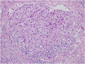 Extraocular sebaceous carcinoma. Neoplasm characterized by polygonal clear cells, nuclear pleomorphism, cell debris, and frequent mitoses (Hematoxylin & eosin, ×40).