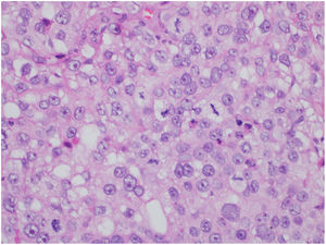 Extraocular sebaceous carcinoma. Detail of neoplastic cells showing nuclear pleomorphism, prominent nucleoli, and multilobular cytoplasm (Hematoxylin & eosin, ×400).
