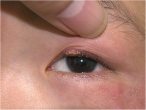 Clinical presentation: erythema with mildly scales on the periocular skin and sesame-sized milky papulopustules on the left upper palpebra.