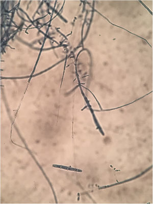 Microscopic examination showed clublike macroconidia and microconidia spores.
