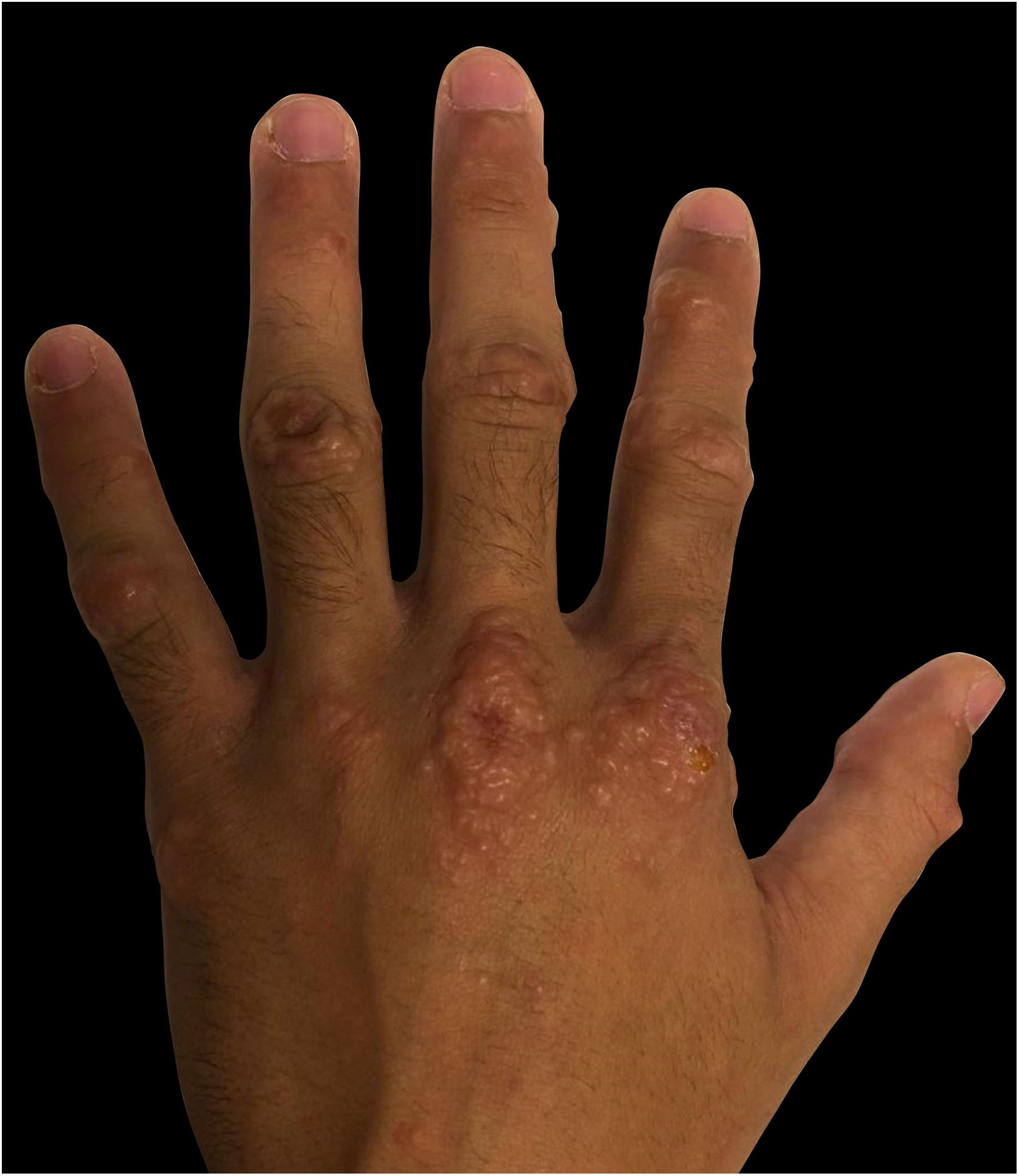 Hand, foot, and mouth disease in adults caused by Coxsackievirus B1B6
