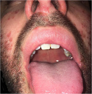 Oral enanthema.
