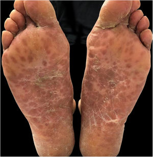 Erythematous purpuric macules and papules, and isolated blisters, located on the feet.