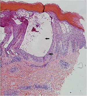 Skin biopsy on the arm showing intraepidermal blister and intense spongiosis (Hematoxylin & eosin, 40×).