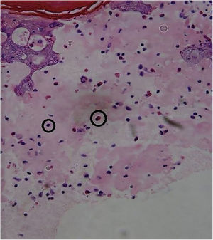 Serous blister formation with eosinophils and lymphocytes are observed. Edematous papillary dermis with mononuclear perivascular infiltration (Hematoxylin & eosin, 400×).