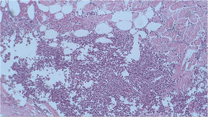 Histopathological examination revealed the presence of a lobular inflammatory infiltrate in the hypodermis (Hematoxylin & eosin, ×100).