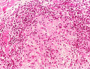 Tuberculoid leprosy. Well-organized epithelioid granuloma, with a dense peripheral halo consisting mainly of lymphocytes. (Hematoxylin & eosin, ×200).