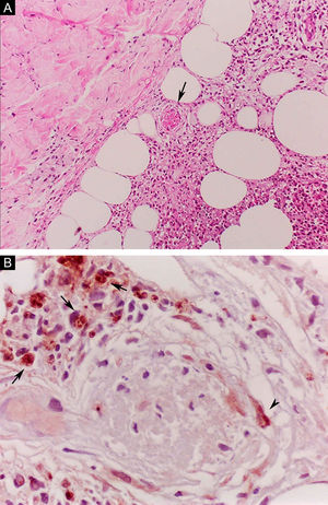 Erythema nodosum leprosum. (A), Involvement of hypodermal lobes with foci of neutrophilic exudation, macrophages, rupture of adipocytes, and blood vessel with thrombosis (arrow) (Hematoxylin & eosin, ×100). (B), Mycobacterial antigenic material in the cytoplasm of macrophages (arrows) and in endothelial cell (arrowhead) of a blood vessel with thrombosis (Immunohistochemical reaction with anti-BCG antibody, ×400).