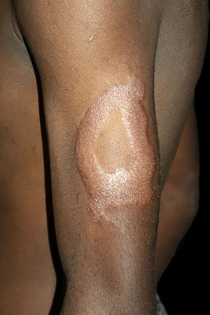 Borderline-tuberculoid leprosy. Indurated-erythematous foveolar plaque, with clear inner and outer edges.